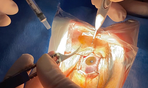 Inyecciones intravítreas