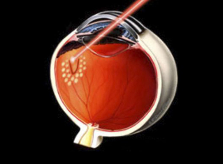 Tratamiento con Láser Argón