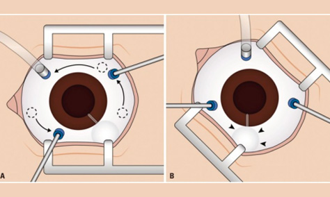 Vitrectomía pars plana